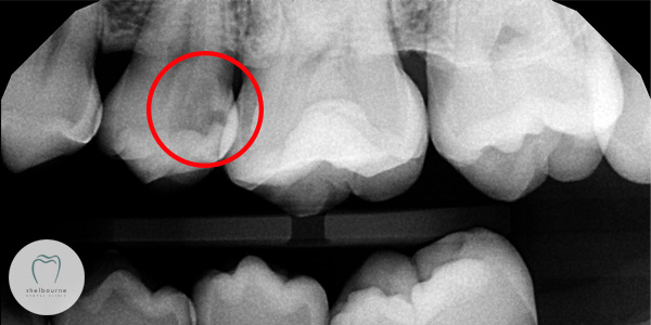 Dental X-ray of tooth decay