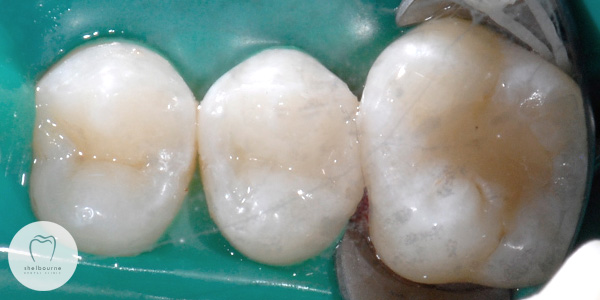 Tooth coloured filling