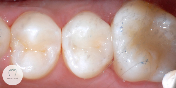 Completed restoration