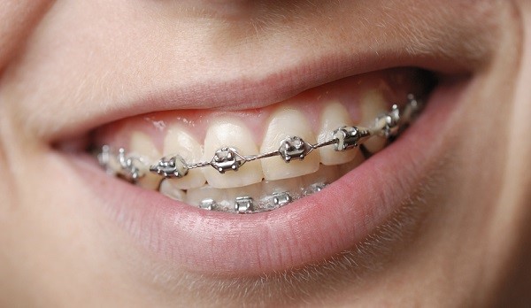 Photo of dental braces 