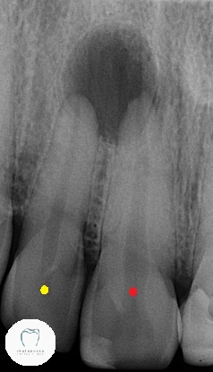 X-ray of teeth that need dental crowns