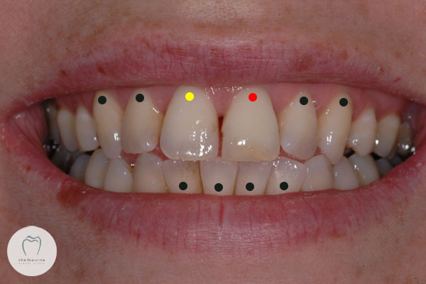 Teeth for crowns
