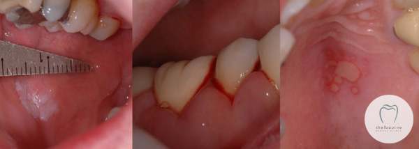 Oral Soft Tissues