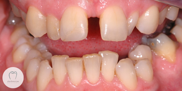 Crooked Teeth