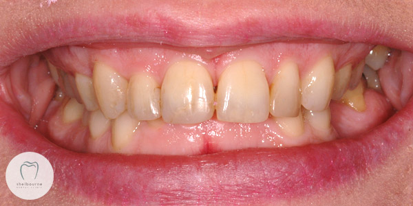 Straight Teeth After Braces