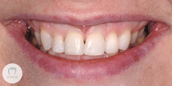 After teeth whitening and cosmetic bonding