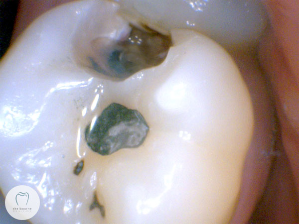 Tooth cavity