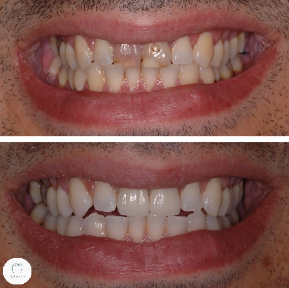 Photo of before and after dental crowns