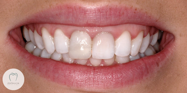 Teeth Whitening Completed