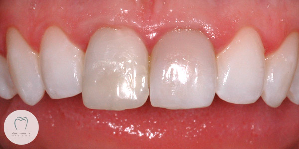 Dark Front Teeth