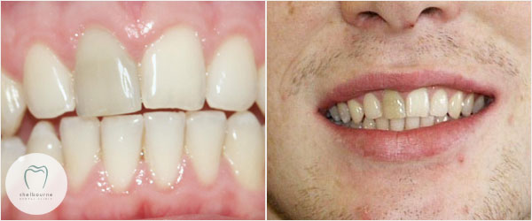 The dark tooth