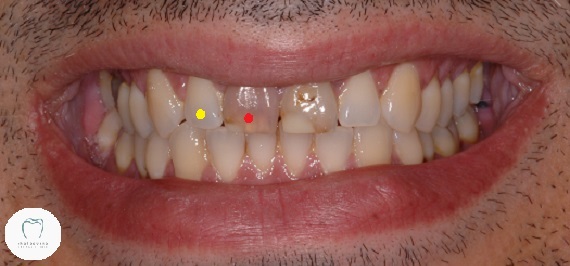Photo of dark teeth that need dental crowns
