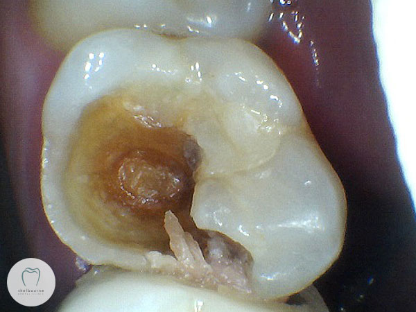 Dental Decay