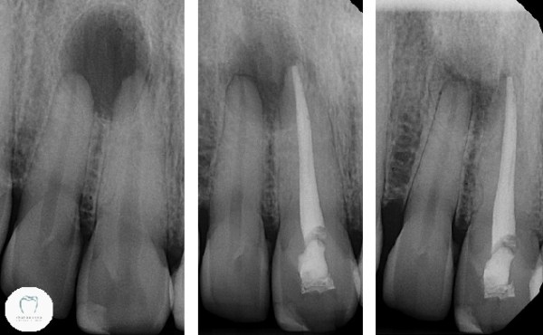 X-ray series showing successful root canal