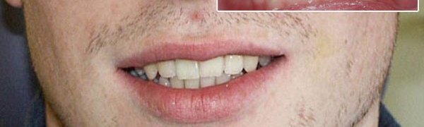 No more dark tooth