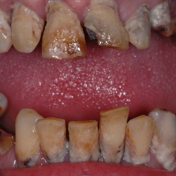 Gum Disease