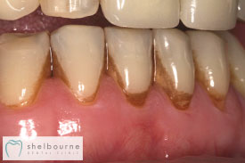 Stained Teeth