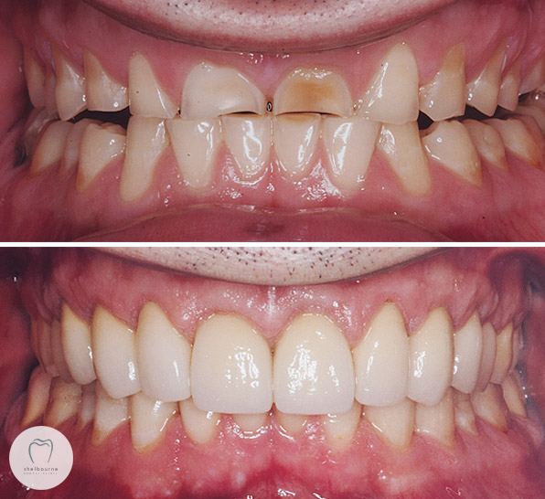 Teeth wear treated with dental crowns