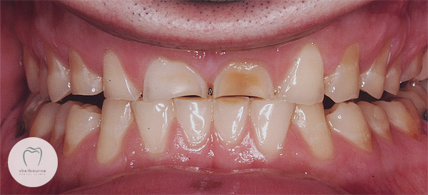 Teeth wear from grinding