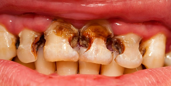 decayed front teeth