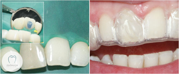 Wearing Teeth Whitening Tray